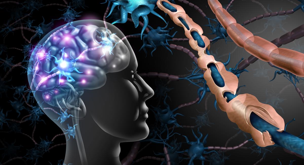 New Study Reveals Surprising Cause of Multiple Sclerosis