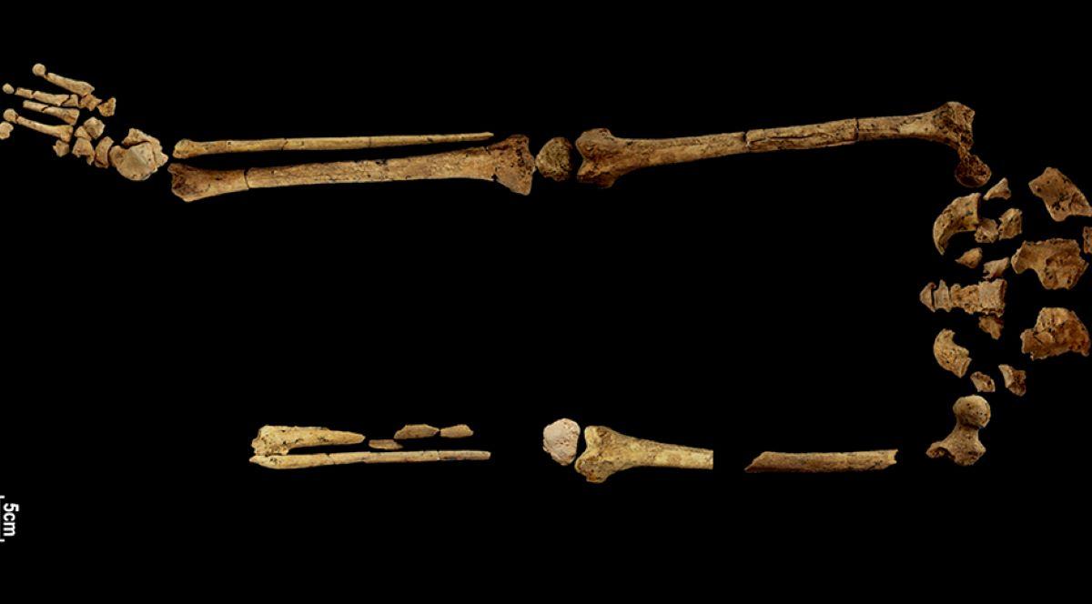 Earliest Known Case of Surgical Amputation Discovered