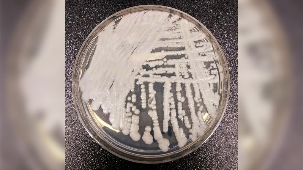 CDC Warns of Dangerous Fungal Infection Spreading Through US at ‘Alarming Rate’
