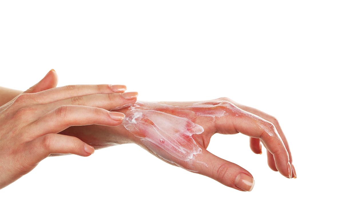 6 Quick, Easy Ways to Treat Burns and Scalds Without Leaving Scars