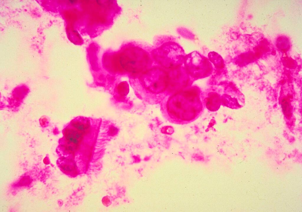 Don’t Believe the Hype: Sugar Alcohols Like Xylitol Are Neither Sugar nor Alcohol and May Increase Your Risk of Breast Cancer