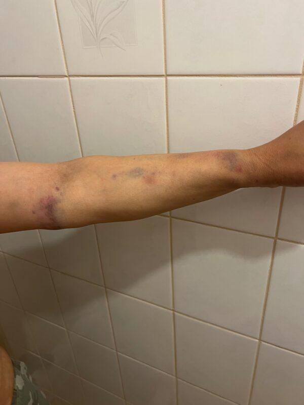 Injuries sustained to the Canberran women during an altercation with pro-CCP men on Oct. 4, 2022 in Canberra, Australia. (supplied)