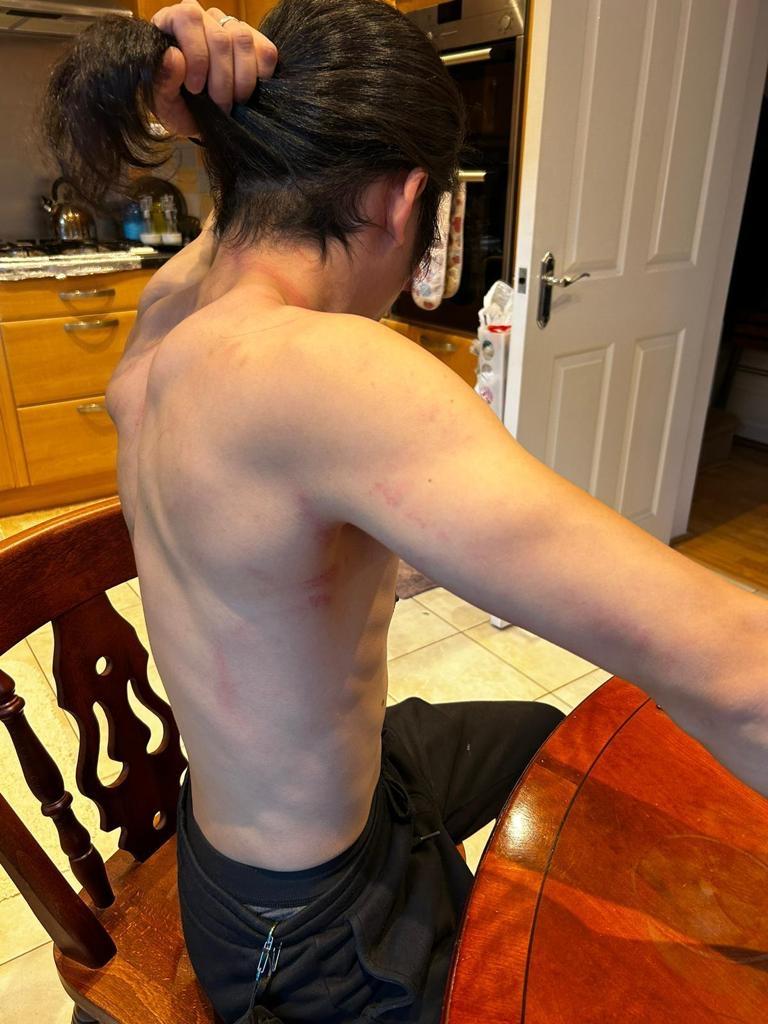Bruises are seen on the body of Bob, a pro-democracy Hong Kong protester who was dragged onto the ground of Chinese consulate and beaten in Manchester, England, on Oct. 16, 2022. (Courtesy of Hong Kong Indigenous Defence Force)