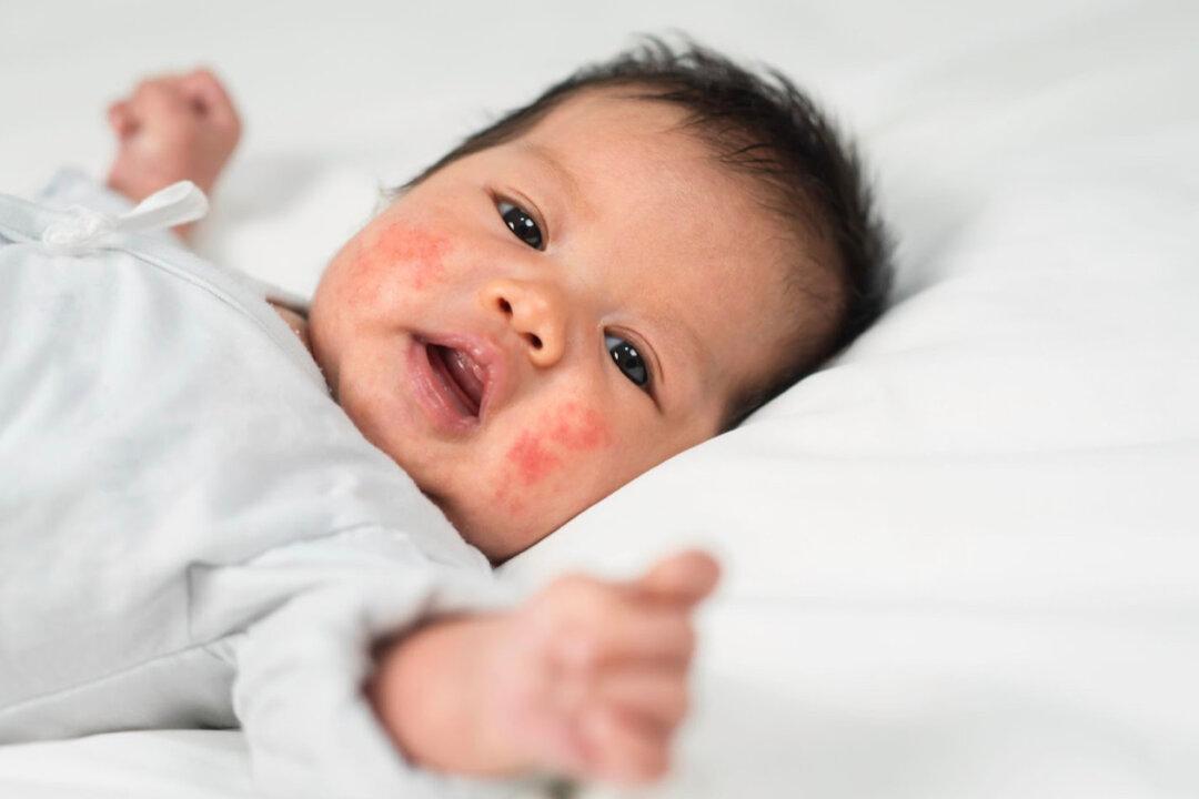 Eczema: Effective Treatment With TCM Acupuncture, Herbs, and Diet