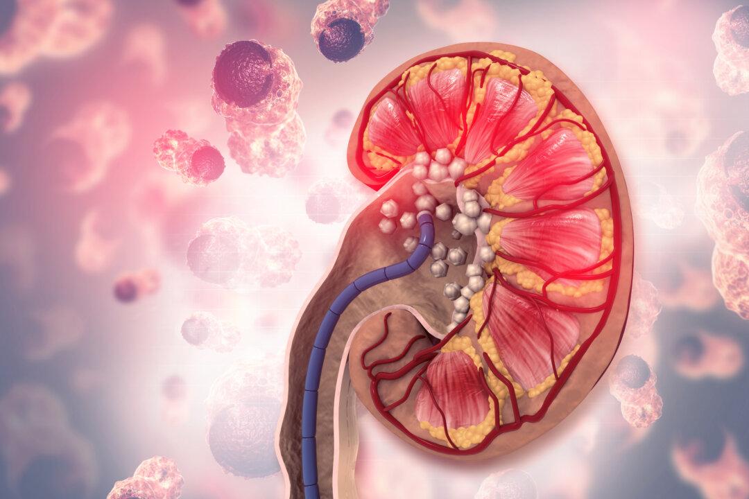 The Simplest Way to Flush Kidney Stones, Other Stones out of the Body