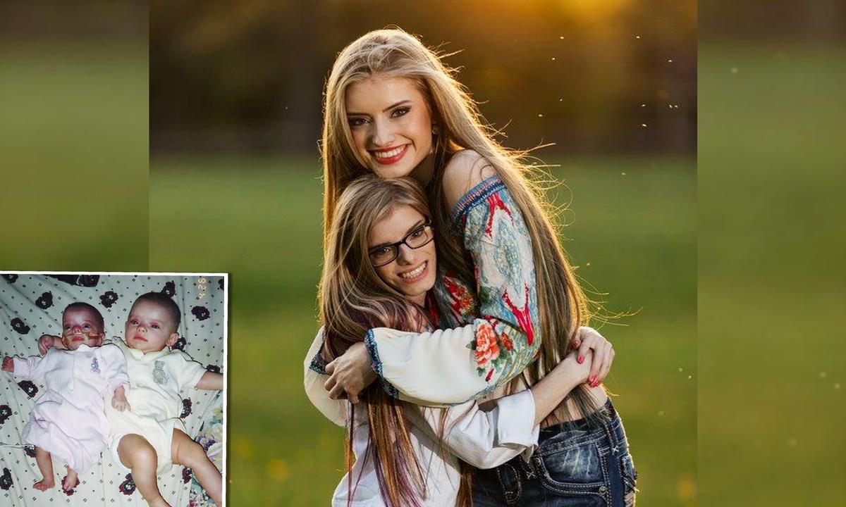 Identical Twin With Dwarfism Shares Special Bond With Protective Sister: ‘She’s My Best Friend’
