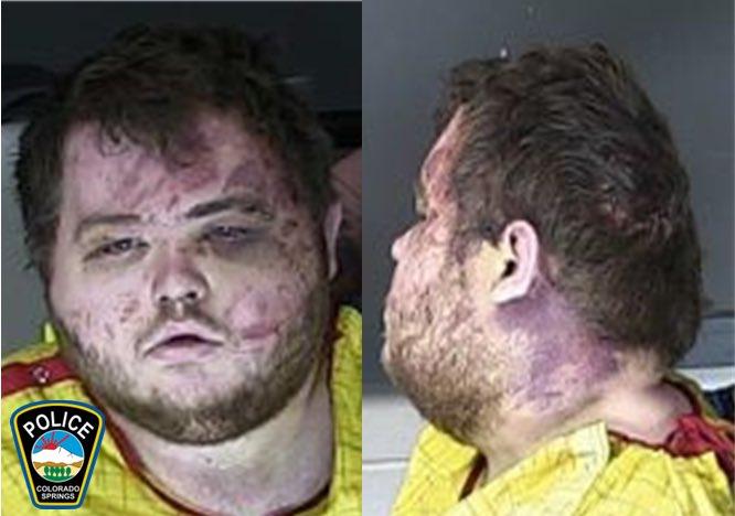 Colorado Gay Nightclub Mass Shooting Suspect Appears Bruised in Court