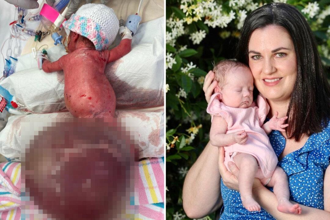 ‘Little Fighter’ Preemie Baby Thrives After Surgeons Remove Spinal Tumor That Was Twice Her Weight