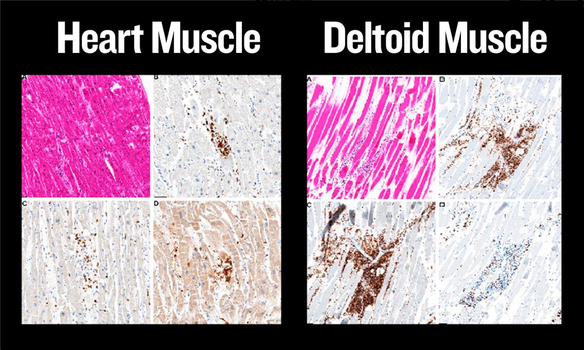 Found Dead at Home After COVID-19 Vaccination