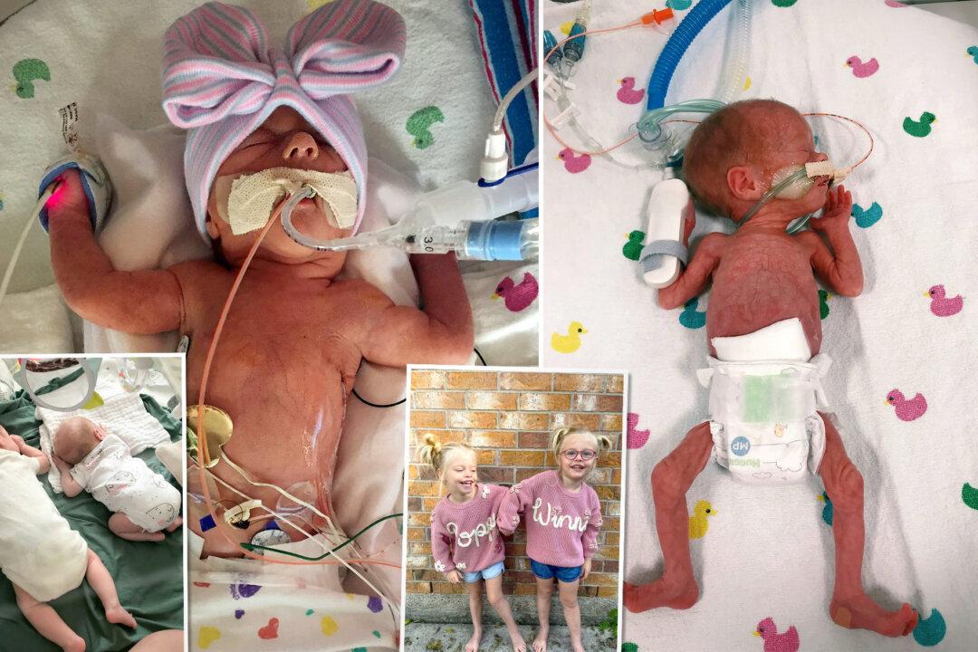 Healthy Twin Saves Her Sister’s Life by Sending Out Distress Signals Forcing Doctors to Deliver Them Early