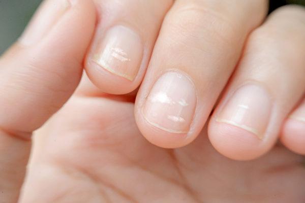 Observing Nails as Indicators of Health Imbalances