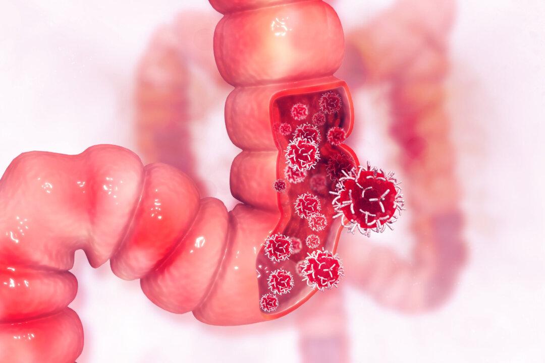 Study Links Popular Food Additive to Colon Cancer