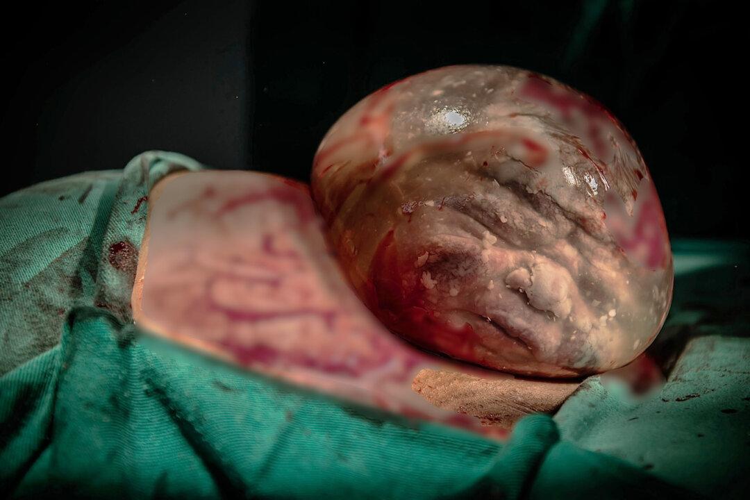 Photographer Captures Incredible Pictures of a Baby Born via Cesarean Section While Still Inside His Amniotic Sac
