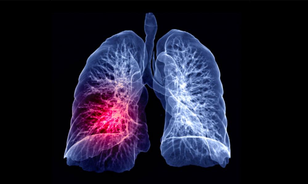 72 Percent of NZ’s Long COVID Sufferers Struggling to Adjust to Normal Life