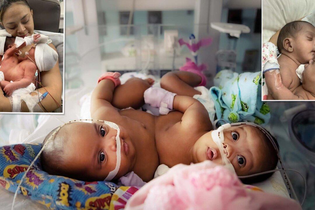 Conjoined Twins Undergo 11-Hour Separation by Team of 27 Medical Staff—Here’s How They Look Now