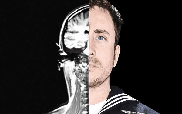 Understanding Veteran TBI: Hormone Imbalances Following Traumatic Brain Injury