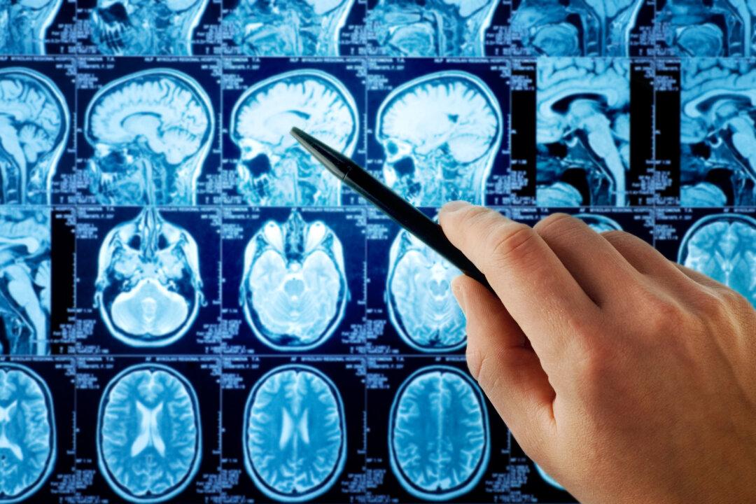 COVID Causes Brain Cells to ‘Fuse and Malfunction’, Study Finds