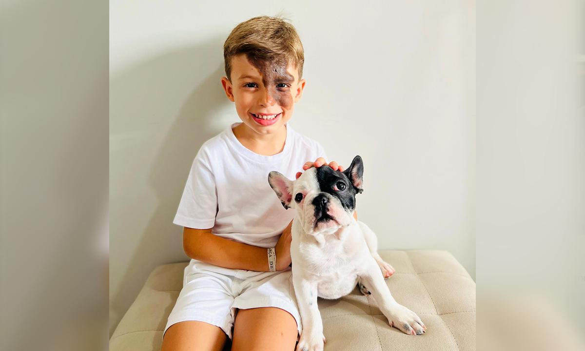 Parents Gift Son With a Unique Birthmark a Dog That Looks Exactly Like Him