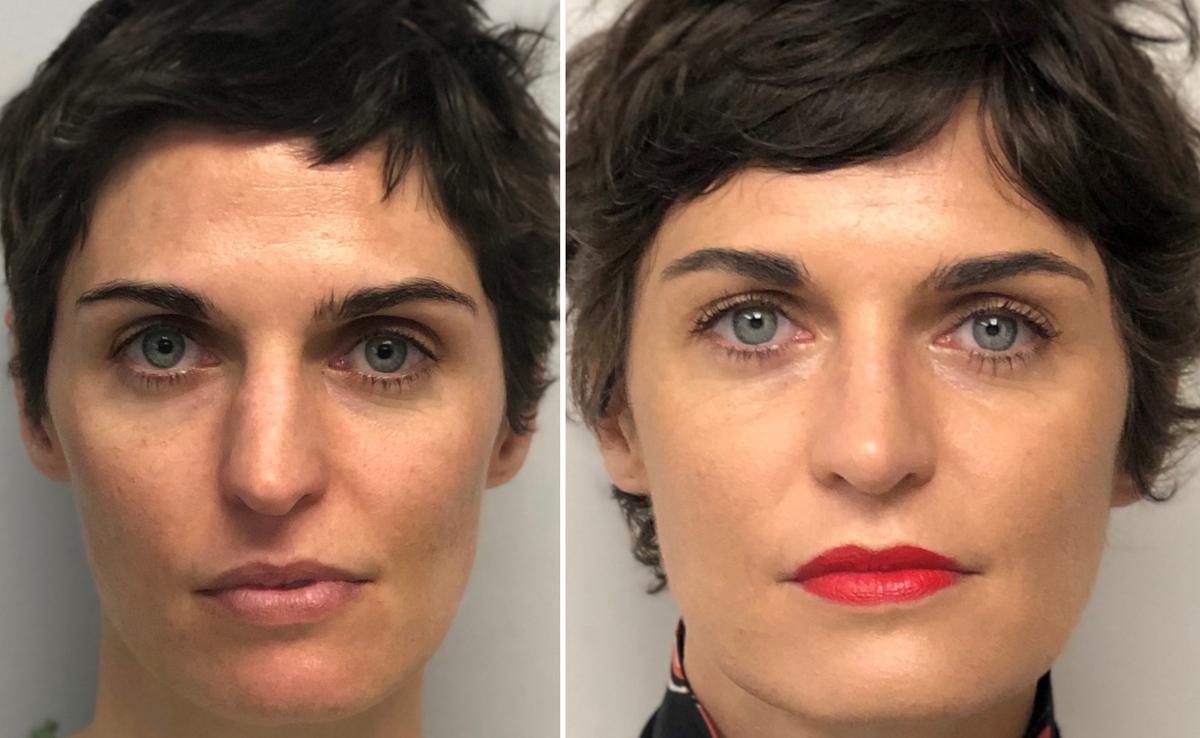 A Conversation With a Real Facial Plastic Surgeon