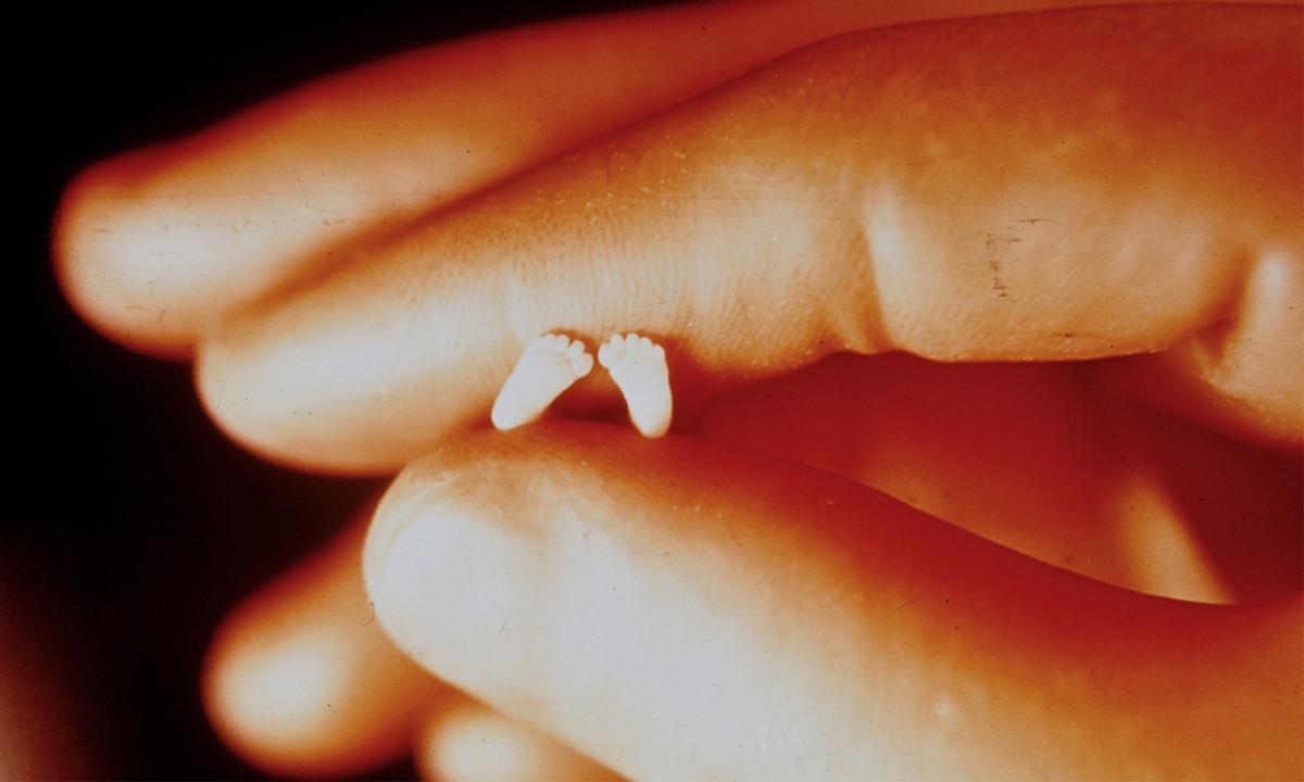 ‘Precious Feet’: Doctor’s Iconic Photo of a 10-Week-Old ‘Fetus’ Proves Aborted Babies Are Not Clumps of Cells