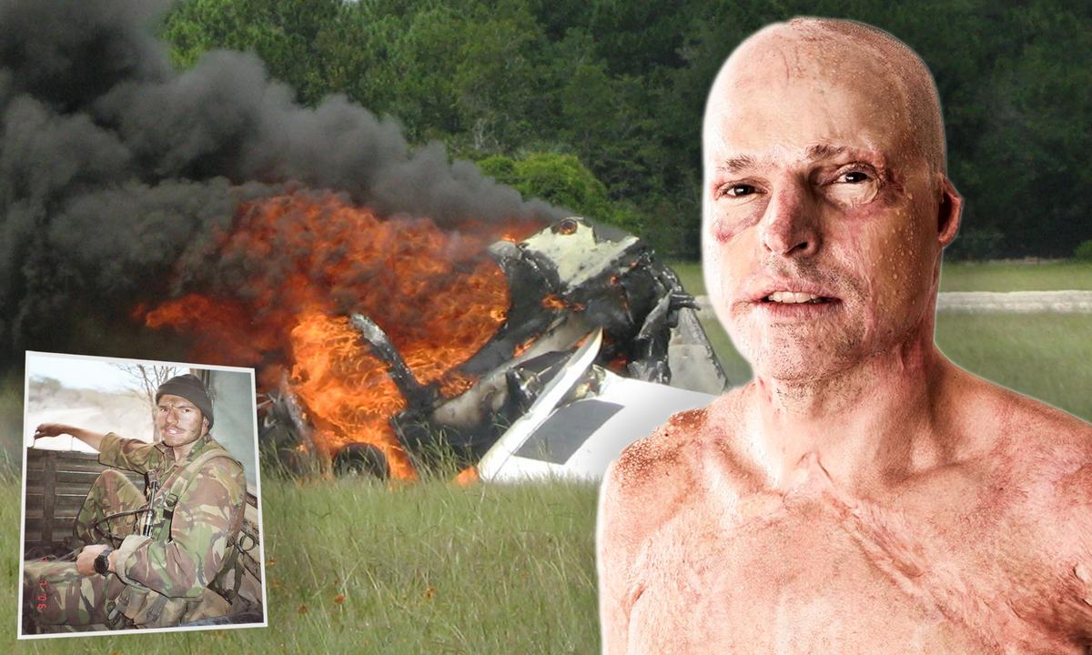 ‘Life on a Thread’: Pilot With 63 Percent Third-Degree Burns Survived His Cockpit Catching Fire