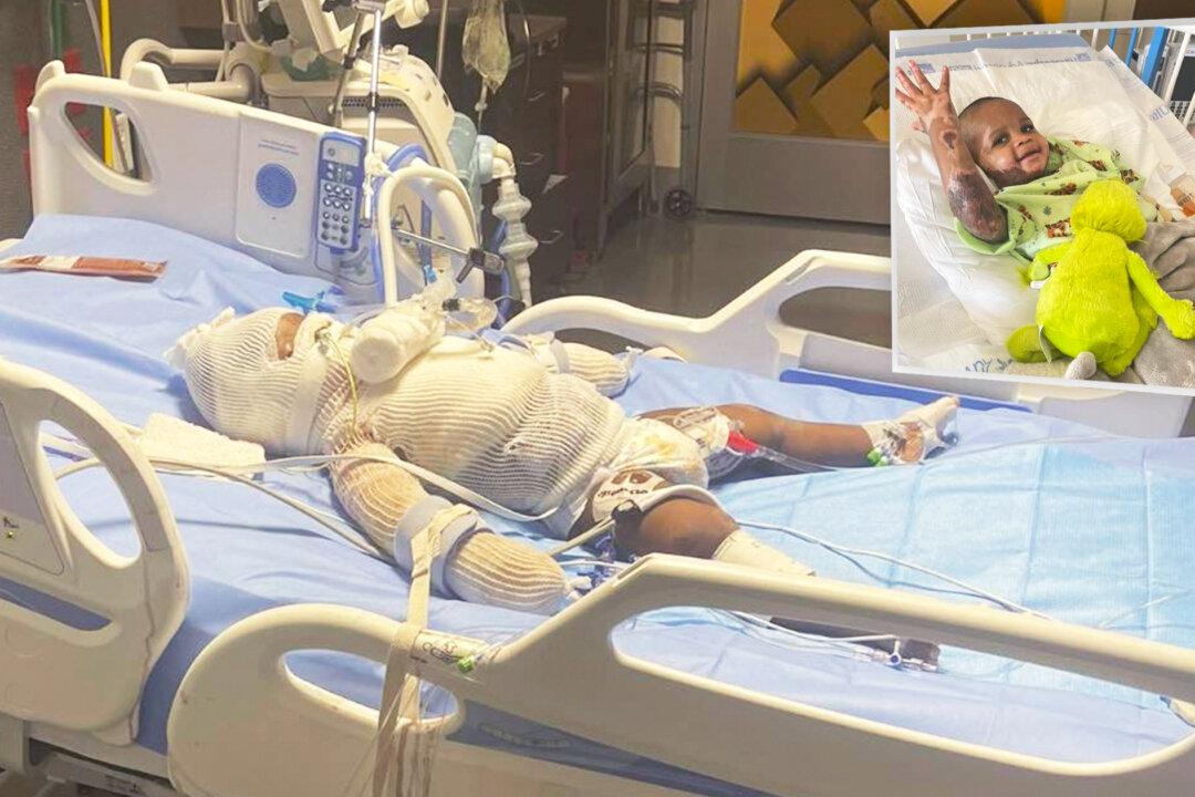 Baby Severely Burned in Candle Explosion Defies the Odds, Proves Nothing Can Dim His Smile