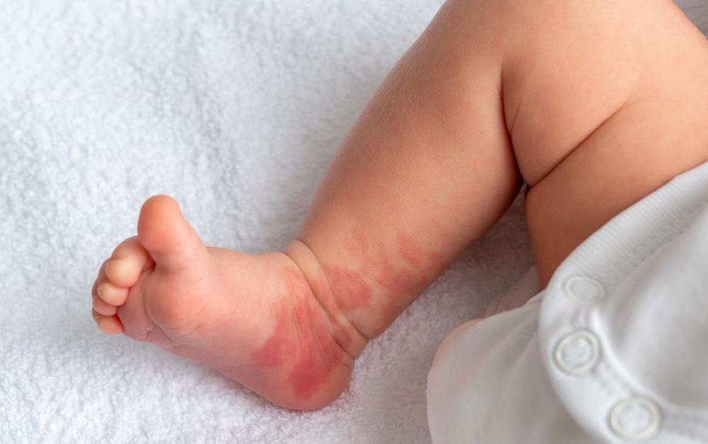 Journey of a Birthmark: Let’s Take a Peek Into Our Past Lives