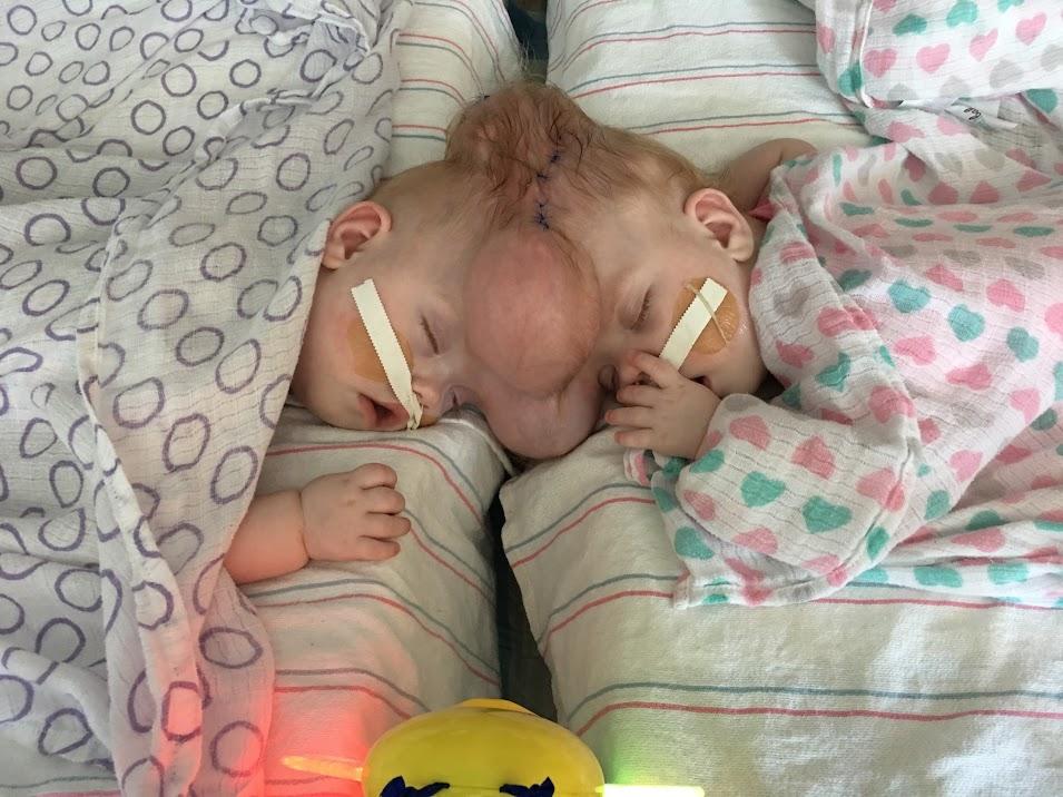 Erin (left) and Abby (right) shortly after they were born. (SWNS)