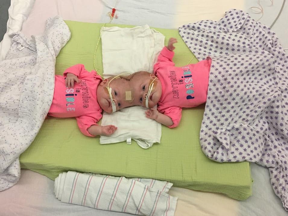 Twins Abby and Erin were born conjoined. (SWNS)