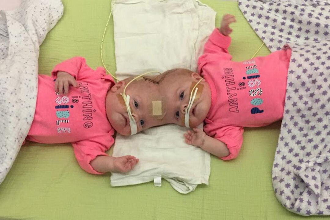 ‘One-in-2.5 Million’ Conjoined Twin Girls Who Survived Separation Surgery Graduate From Kindergarten: PHOTOS