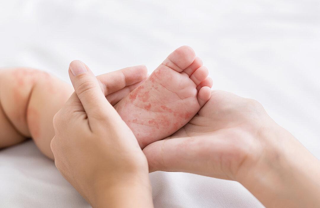 Measles Making a Comeback, and It’s Never Really Gone