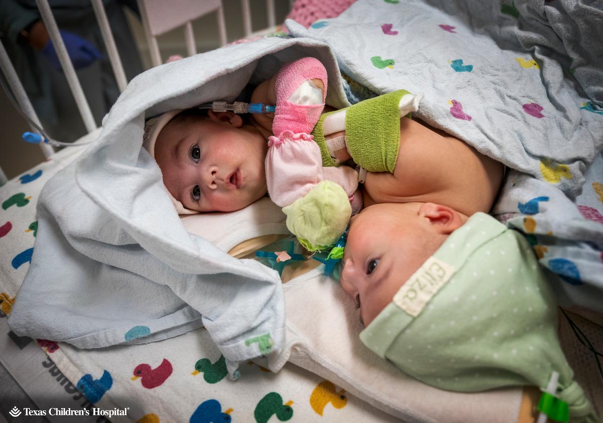 Formerly Conjoined Twins Welcomed Home 4 Weeks After Surgery