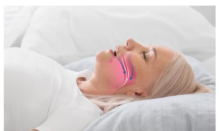 New Device Offers Hope for Sleep Apnea Patients Frustrated With CPAP