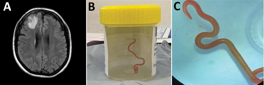 ‘Alive and Wriggling’: 8 Centimetre Worm Extracted From Woman’s Brain