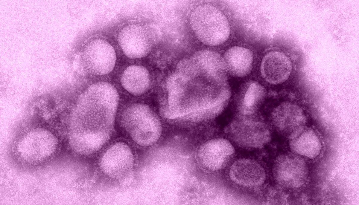 1st Human Case of Swine Flu Variant Detected as Officials Scramble to Find Contacts