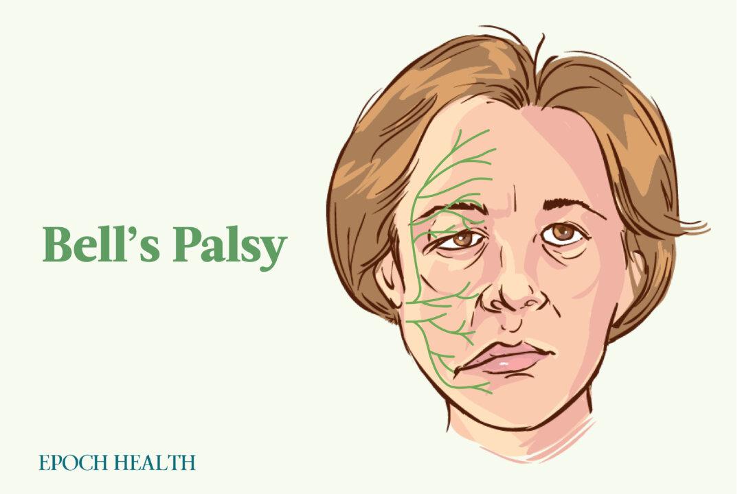 Bell’s Palsy: Symptoms, Causes, Treatments, and Natural Approaches