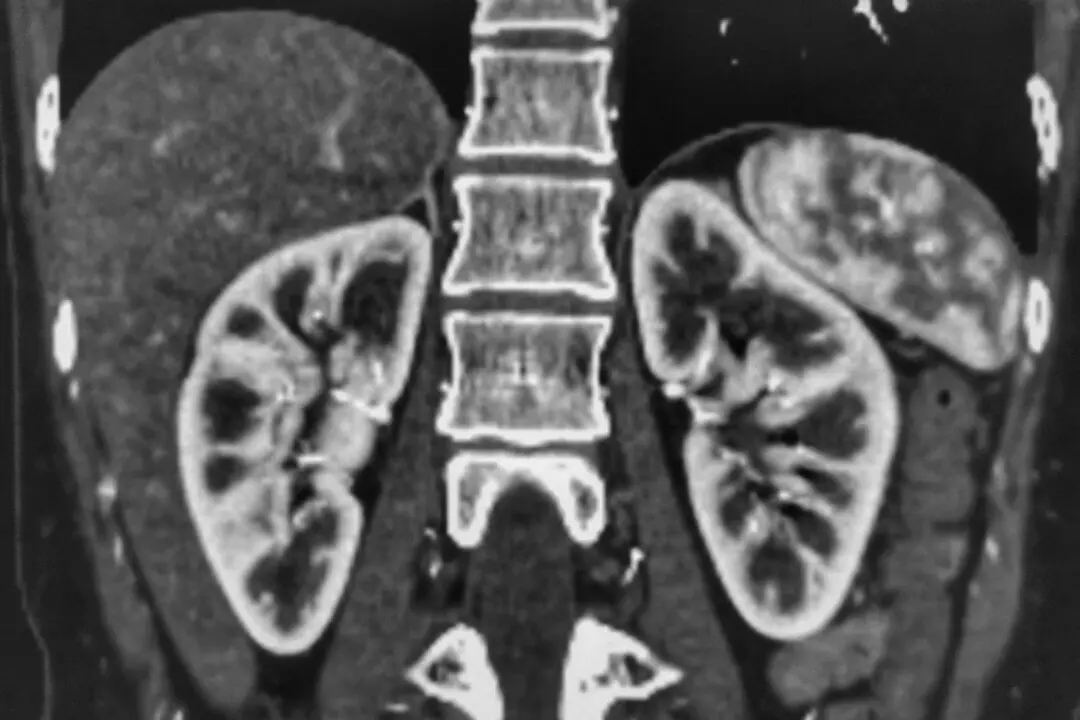 New Zealand Fudged the Data on How the Kidneys Fare After the COVID Vaccines