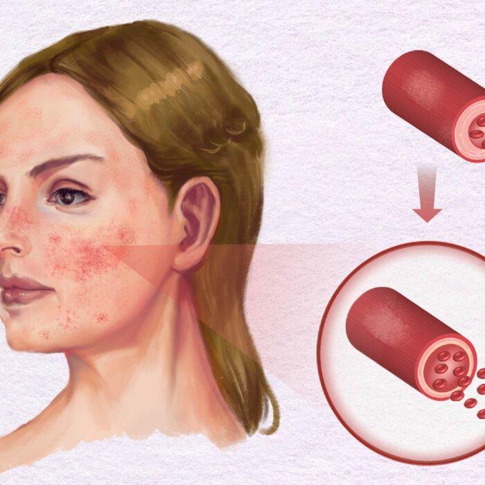 Rosacea: Symptoms, Causes, Treatments, and Natural Approaches