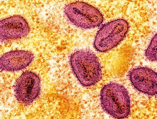 Severe Mpox Virus Strain Possibly Spreading in LA County, Officials Warn
