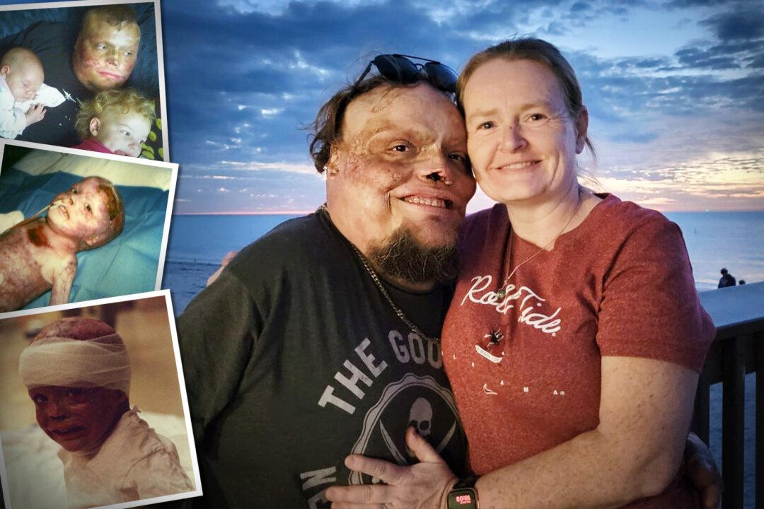 Man With His Body Covered in Burn Scars Shares Gratitude: “Being Different Has Its Challenges, but It Also Has Its Rewards
