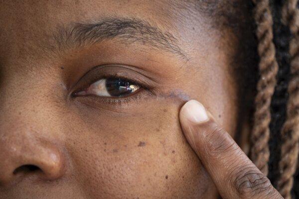 A small scar at the corner of Ruvimbo Kaviya’s eye after she received the surgery, in an undated photo. (Danny Lawson/PA)