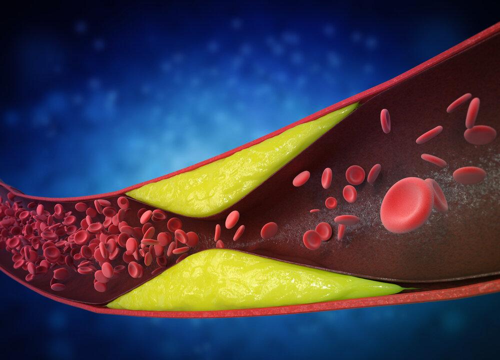 Protecting Your Heart: How High Cholesterol and Emotional Health Affect Atherosclerosis