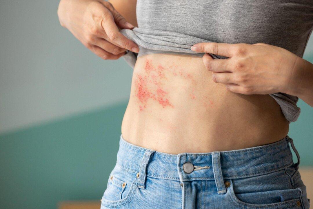 Healing Shingles Naturally: Herbal Recipes to Boost Immunity and Protect Your Nerves