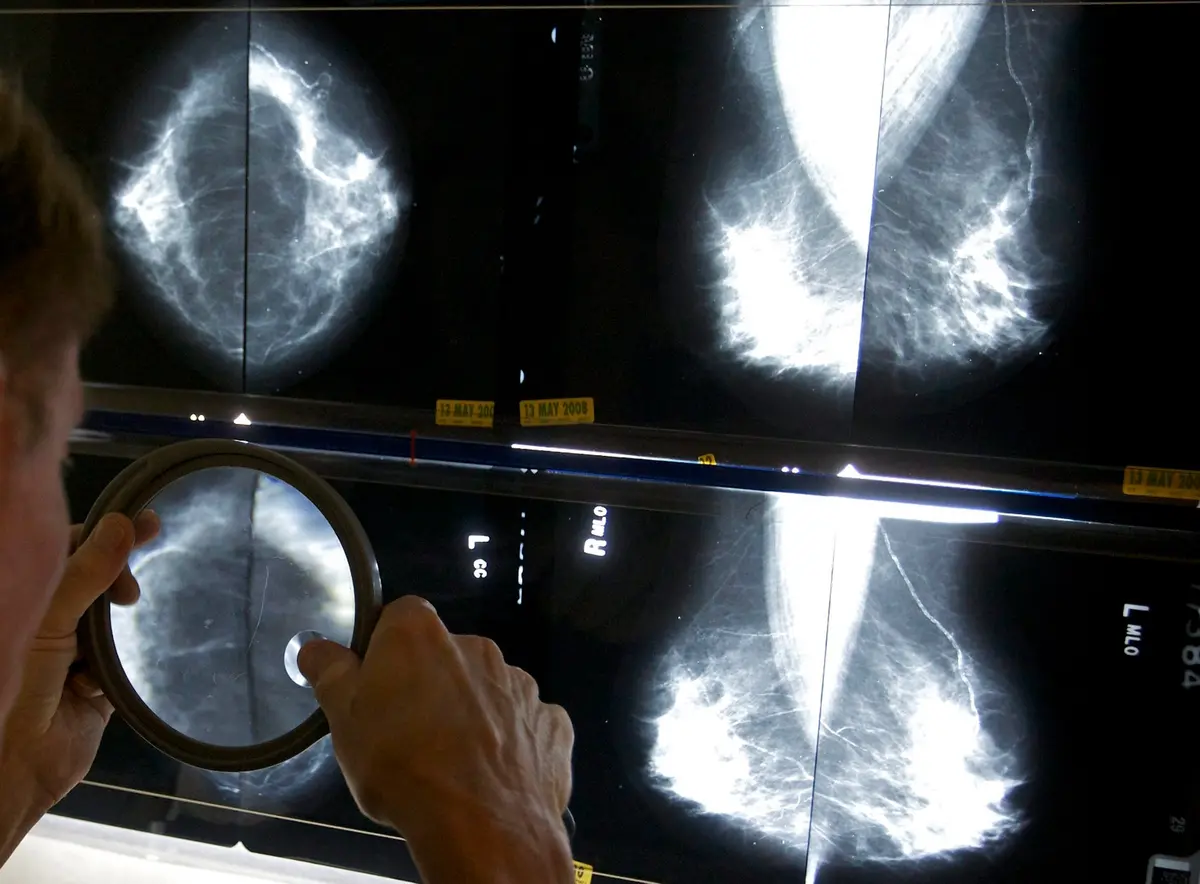 How Breast Cancer Rates Vary by Region in Canada