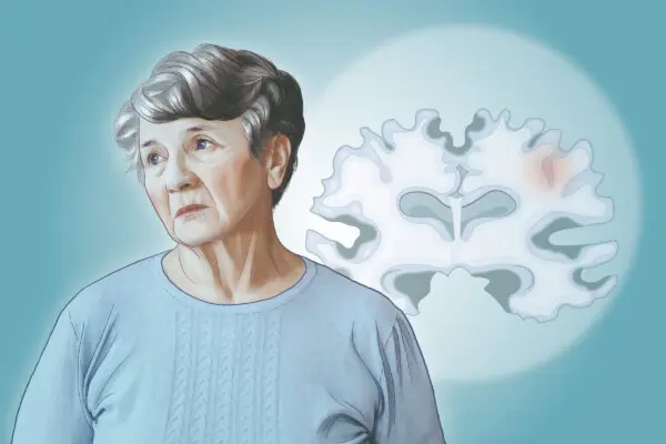 Alzheimer’s Disease: The Most Common Neurodegenerative Disease—Here are the Causes