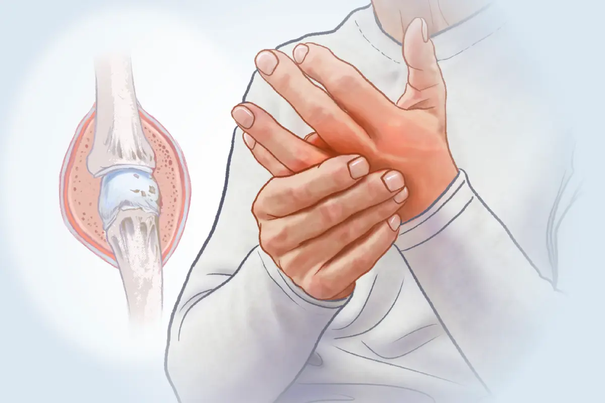 Rheumatoid Arthritis: When the Immune System Attacks Your Joints–Symptoms to Watch For thumbnail