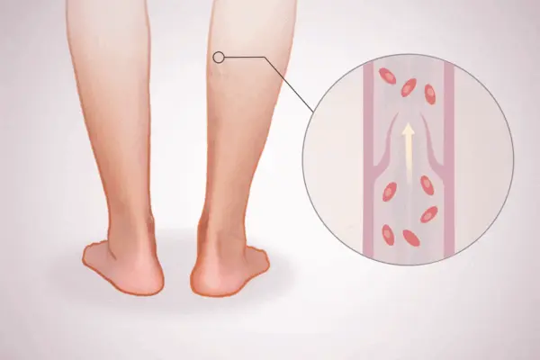 Deep Vein Thrombosis: How Slow Blood Flow Leads to Harmful Clots–Key Symptoms to Watch For
