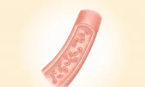 Atherosclerosis: The Silent Buildup Narrowing Your Arteries—Warning Signs to Watch For