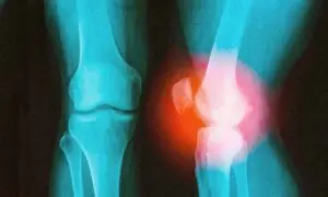 How a Surgeon With a Damaged Knee Learned to Outsmart Arthritis