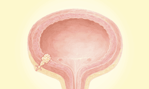 Bladder Cancer: Most Common Cancer of the Urinary System–Here Are the Warning Signs